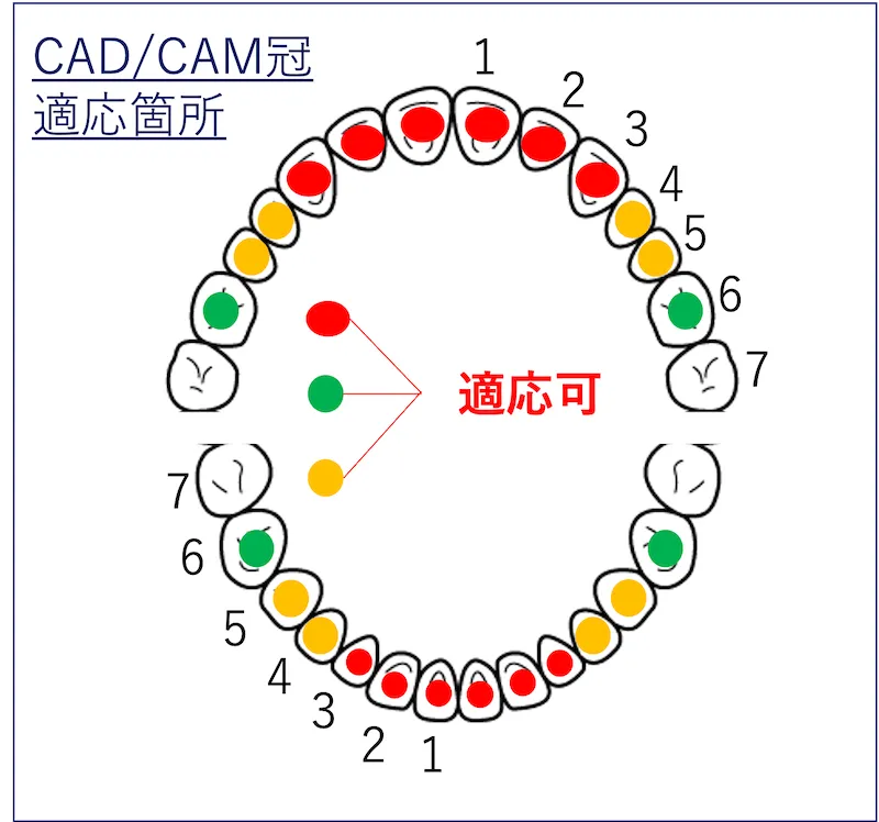 CAD/CAM冠適応箇所