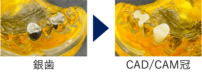 CAD/CAM冠の特徴
