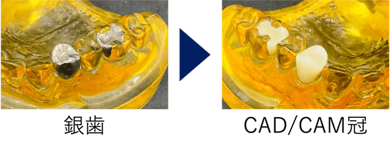 CAD/CAM冠の特徴
